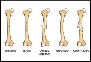 Fracture